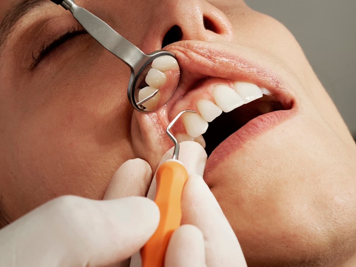 Implantes Dentários